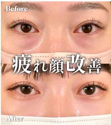 症例写真 疲れ顔改善