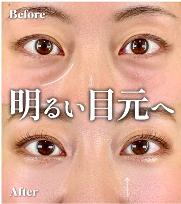 症例写真 明るい目元へ