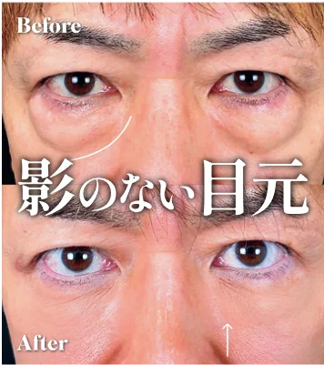 症例写真 影のない目元