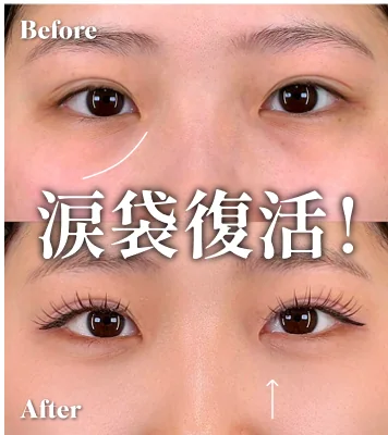 症例写真 涙袋復活