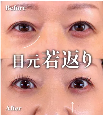 症例写真 目元若返り