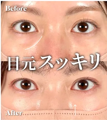 症例写真 目元スッキリ