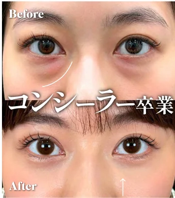 症例写真 コンシーラー卒業