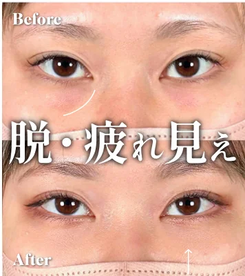 症例写真 脱・疲れ見え