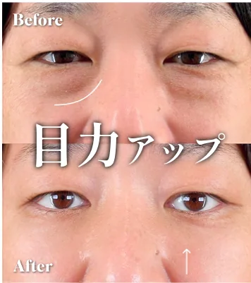 症例写真 目力アップ