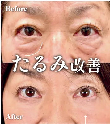 症例写真 たるみ改善