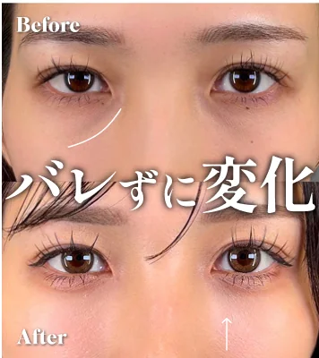 症例写真 バレずに変化